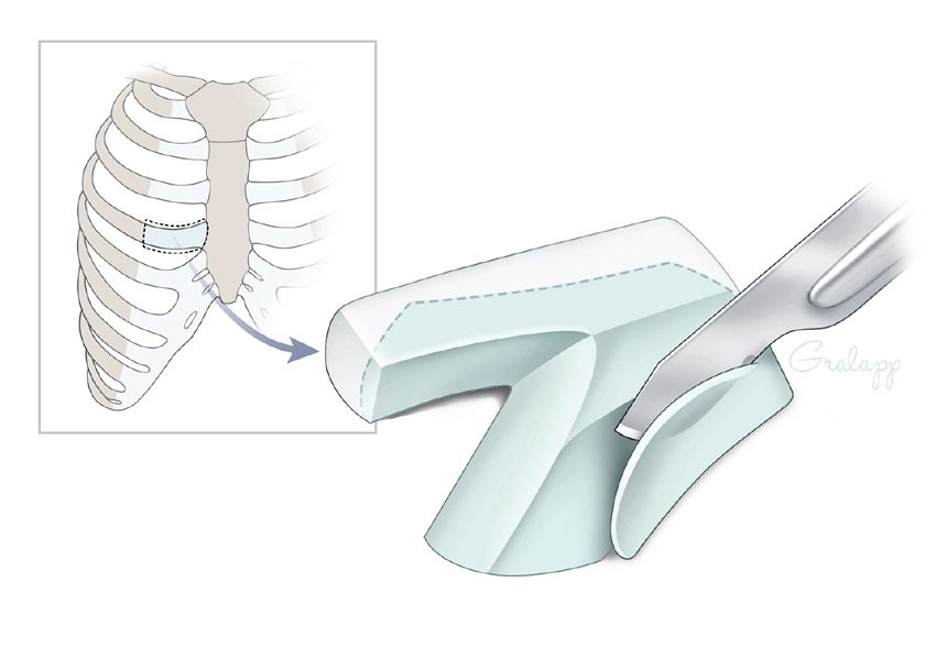 Rib harvest - natural adam's apple surgery