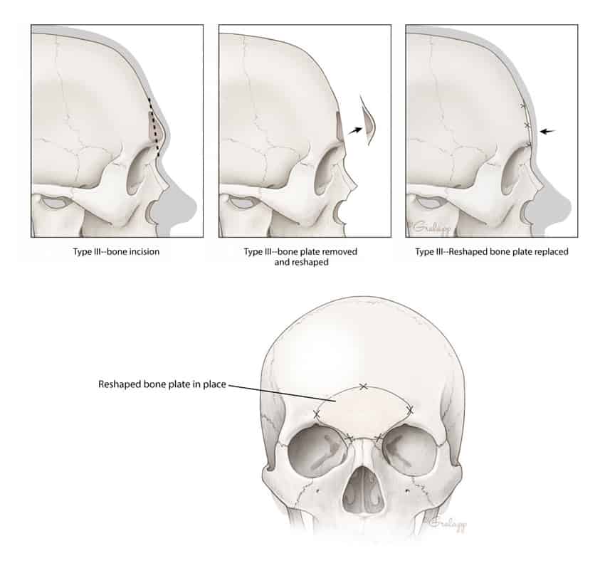 Forehead Reduction (Contouring or Reshaping) Surgery
